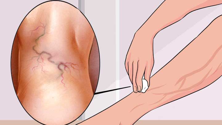 वेरीकोस वेंस का उपचार 