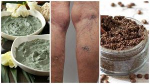 वेरीकोस वेंस से छुटकारा दिलाएंगे ये घरेलू नेचुरल तरीके