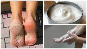 पैर पर लगे फंगस और घट्ठे को इस अद्भुत घरेलू ट्रीटमेंट से दूर करें