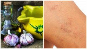 ऑलिव ऑयल और लहसुन से करें नसों की सूजन का नेचुरल ट्रीटमेंट