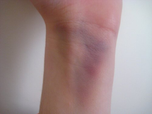 चोट में आराम देते हैं केले के छिलके