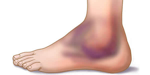 6 सुझाव टखने की मोच से बचने और इसे ठीक करने के लिए