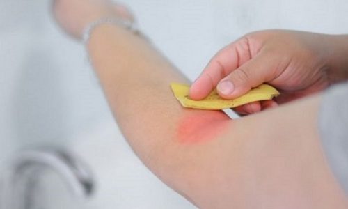 कीड़े के काटे ज़ख्म पर असर करते हैं