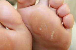 4 घरेलू नुस्ख़े से करें घट्टों का इलाज