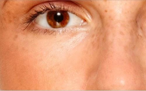 पॉलीसिस्टिक ओवेरियन सिंड्रोम: चित्तियाँ पड़ना