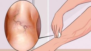 8 बेजोड़ एक्सरसाइज जो वेरीकोस वेंस का इलाज करती हैं