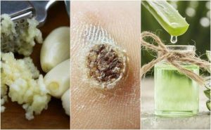 इन 5 घरेलू नुस्खों की मदद से मस्सों से छुटकारा पायें
