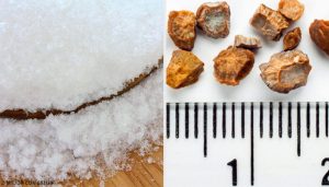 7 घरेलू नुस्ख़े जो दिलाएंगे किडनी स्टोन से छुटकारा