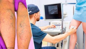 वेरीकोस वेंस की समस्या से छुटकारा दिलाएंगे ये नेचुरल ट्रीटमेंट