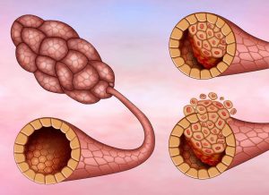 ब्रैस्ट कैंसर: डक्टल कार्सिनोमा