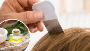 जुओं से छुटकारा पाने के 6 घरेलू उपाय