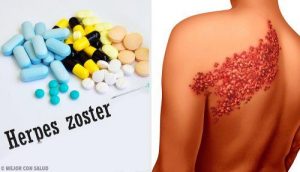 हर्पीस जॉस्टर के लक्षण और निदान के बारे में अहम तथ्य