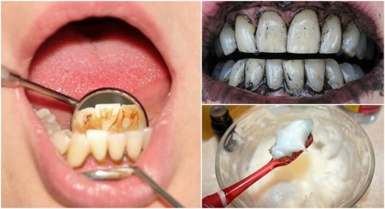 दांतों के टार्टर की सफ़ाई के लिए 3 जोरदार घरेलू ट्रीटमेंट