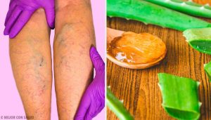 एलोवेरा से वेरीकोस वेंस का इलाज करें