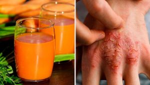 इन 7 प्राकृतिक उपायों से करें सोरायसिस से मुकाबला और उसकी रोकथाम