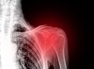 कंधे का दर्द करें छूमंतर इन आसान घरेलू उपचारों से