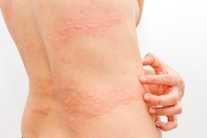 पित्ती (Hives) के लिए तीन नेचुरल ट्रीटमेंट