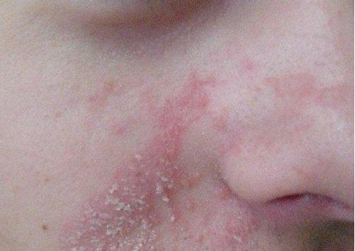 सेबोरिक डर्मटाइटिस