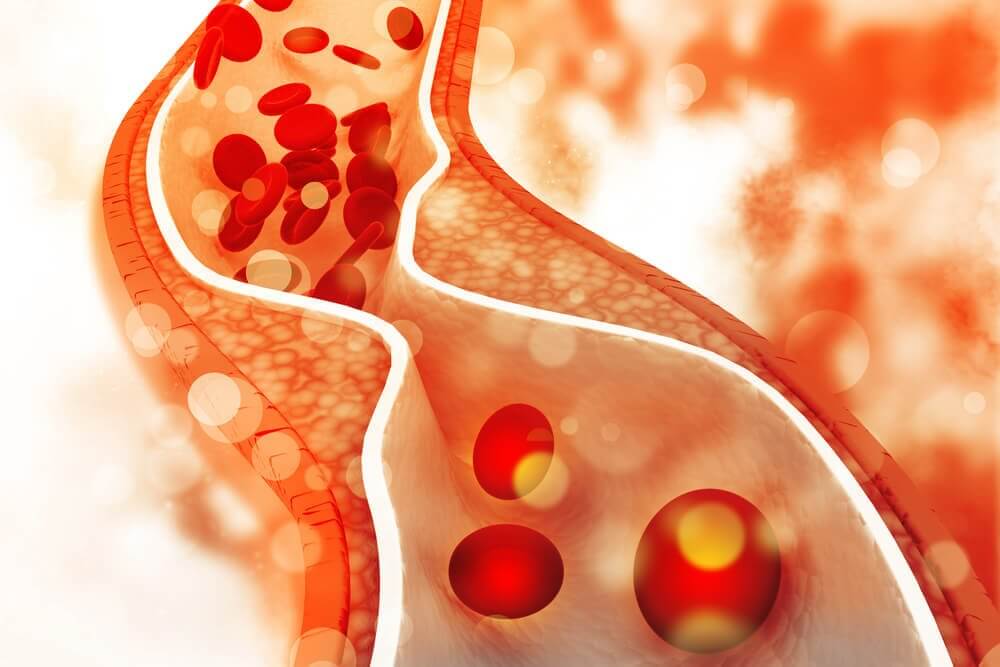 खराब कोलेस्ट्रॉल (LDL) पर स्वस्थ आहार से काबू पायें