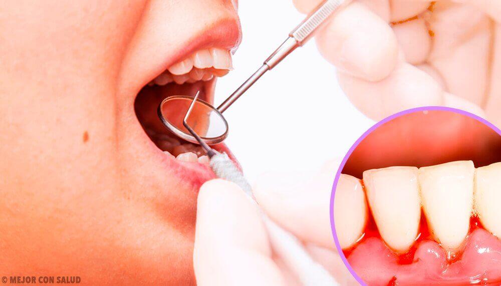 मसूड़ों का इन्फेक्शन