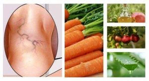 वेरीकोस वेंस से छुटकारा पाने के लिए आजमाएं ये 3 प्राकृतिक इलाज