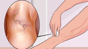 वेरीकोस वेंस के इलाज के घरेलू नुस्खे