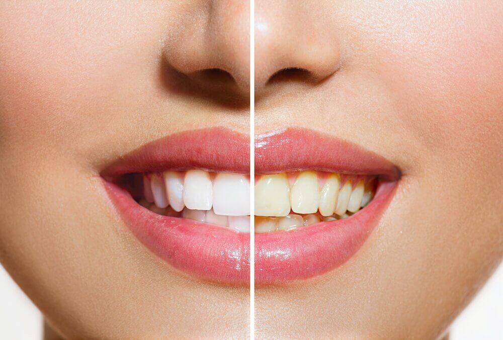 प्राकृतिक उत्पाद जो रखते हैं आपके दांतों को सफ़ेद और चमकदार