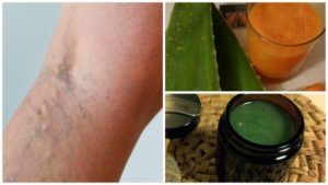 वेरीकोस वेंस को ठीक करने के लिये दादी माँ का नुस्खा