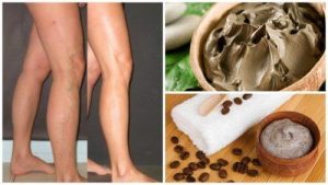 5 नेचुरल तरीके वेरीकोस वेंस का मुकाबला करने के लिए