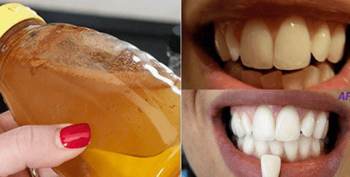 एप्पल साइडर विनेगर: इस सौ प्रतिशत प्राकृतिक सामग्री से अपने दांत चमकायें
