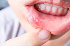 मुंह के छालों का इलाज करने के लिए 7 घरेलू उपचार
