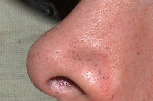 नींबू के छिलके का इस्तेमाल कर मुहांसों से छुटकारा पाएं