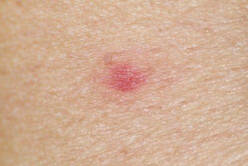 6. कीड़ों के काटने पर (Insect bites)