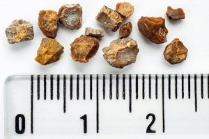 किडनी स्टोन से लड़ने के 6 घरेलू नुस्खे