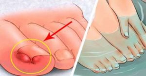 6 घरेलू नुस्खे अंदर की ओर बढ़े पैरों के नाखून के लिए