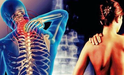 सर्विकोब्रैकियल सिंड्रोम: दर्द आपकी गर्दन से होकर बाजुओं तक जाता है