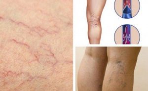 लाइफस्टाइल में ये बदलाव करके अपनी नसों की सेहत सुधारें