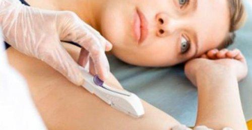 सबडर्मल कान्ट्रसेप्टिव इम्प्लांट क्या हैं?