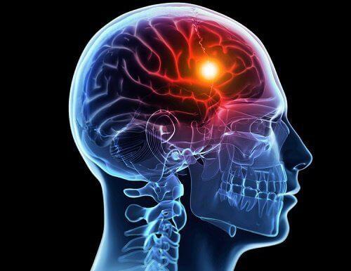 8 चेतावनी सूचक लक्षण जो ब्रेन स्ट्रोक से पहले आपका शरीर देता है