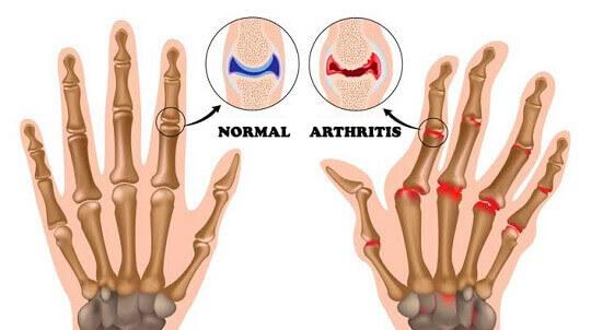 कार्टिलेज की मदद से आर्थराइटिस का इलाज