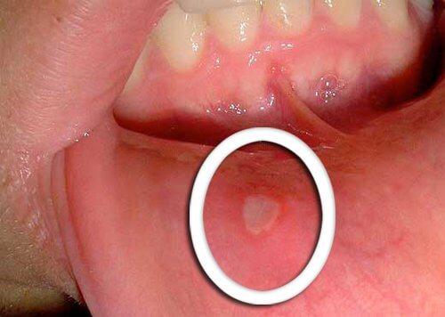 मुंह के छाले ऑरोफरीन्जियल कैंसर की निशानी हो सकते हैं