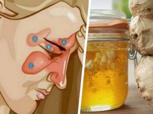 साइनोसाइटिस से राहत पाने के लिए दो सामग्रियों का असरदार योग