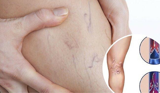 वेरीकोस वेंस के इलाज के लिए आर्निका मरहम