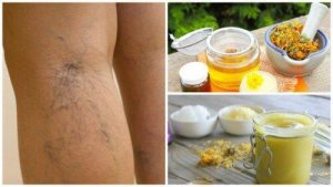 वेरीकोस वेंस के इलाज के लिए आर्निका मरहम का उपयोग कैसे करें