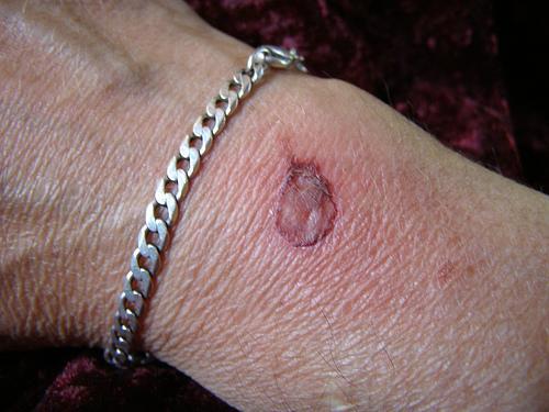 बर्न्स के प्रकार और लक्षण