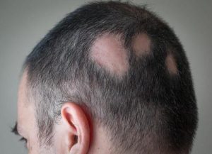 प्राकृतिक साधनों से एलोपिसिया का प्रतिरोध कैसे करें