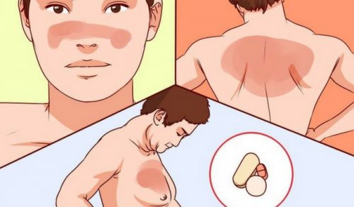 ल्यूपस रोग के बारे में आपको क्या जानना चाहिए