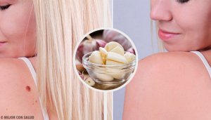 9 नेचुरल नुस्ख़े जो झटपट हटाएंगे मस्से