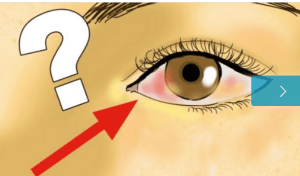 बातें जो एक डिटैच्ड रेटिना के बारे में आपको जाननी चाहिए