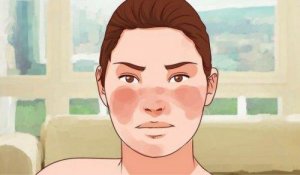 ल्यूपस पर काबू पाने के 7 उपाय